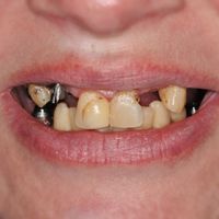 Dental Bridges - Smile 2 before